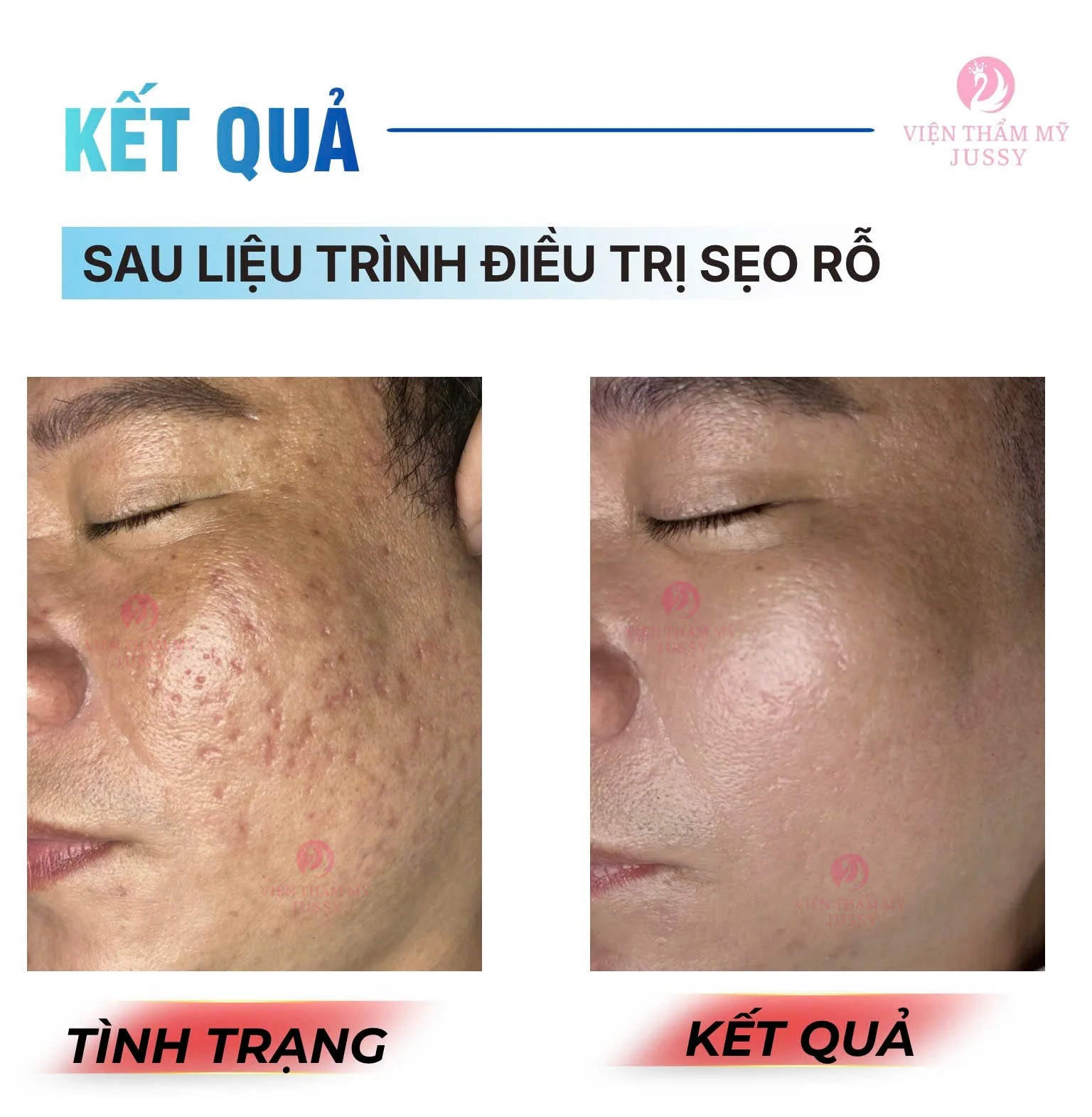 Đặt Lịch Peel Da Chuẩn Y khoa