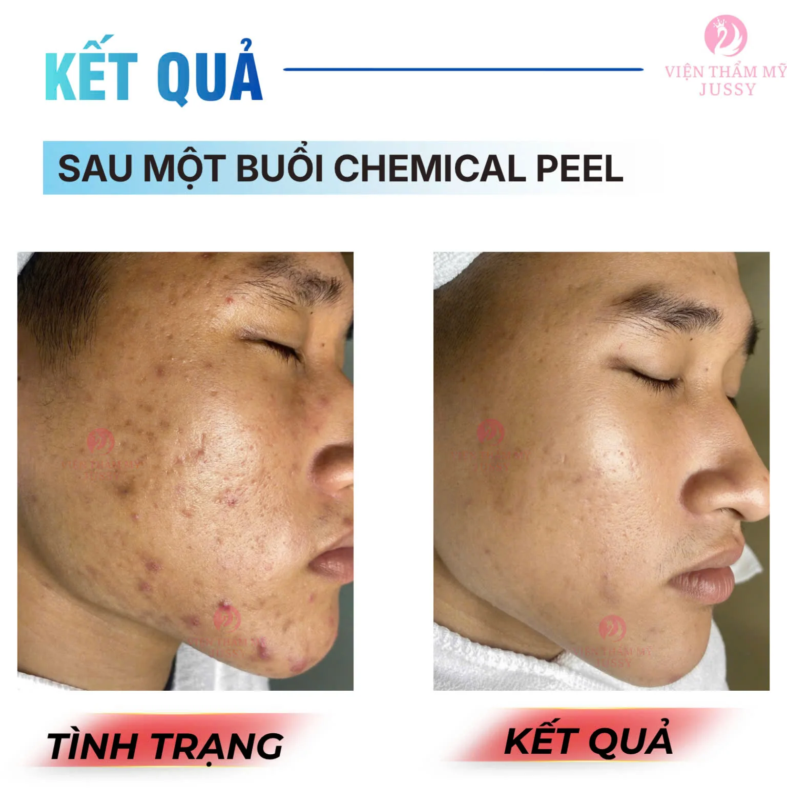 Đặt Lịch Peel Da Chuẩn Y khoa